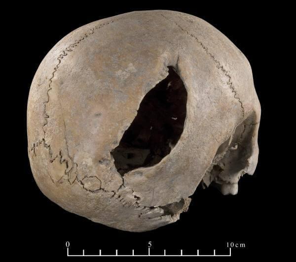 Large trepanation on the right side of the parietal bone of the skull